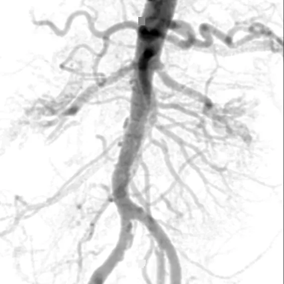 Simulated abdominal aortic flush, AP